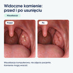 Wizualizacja komputerowa przed i po usunięciu widocznych kamieni migdałkowych. Nie zdjęcia pacjenta.